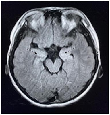 Clinical Characteristics and Follow-Up of Seizures in Children With Anti-NMDAR Encephalitis